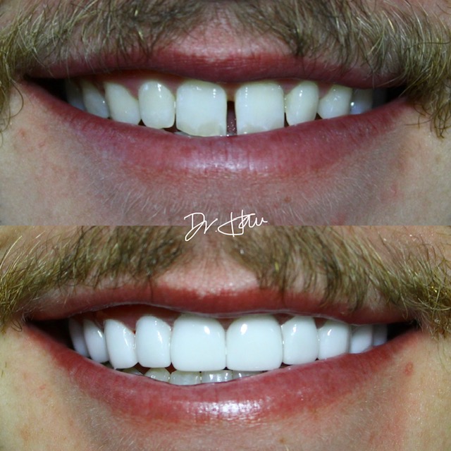 Teeth Gaps Perth