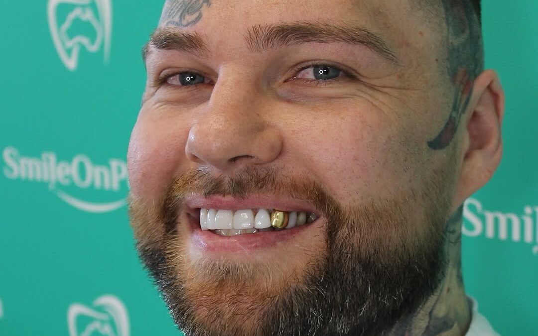 Veneers 101: From Enhancing Your Smile to Proper Cleaning and Care