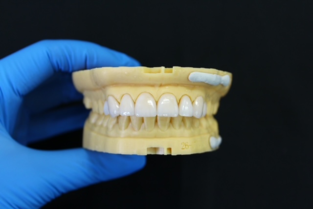 Full Mouth Dental Rehabilitation Options