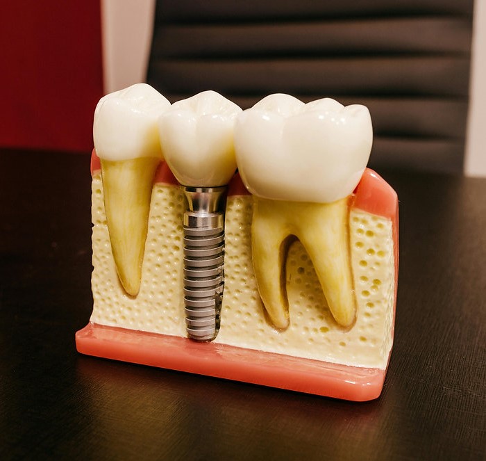 Dentures Versus Implants for a Confident Smile